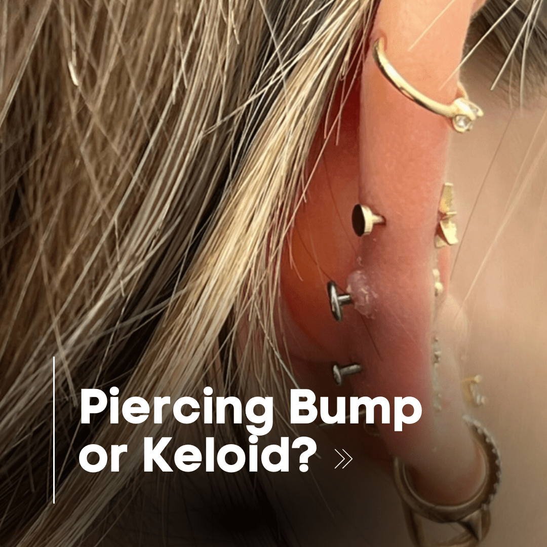 Understanding the Difference Between Piercing Bumps and Keloids